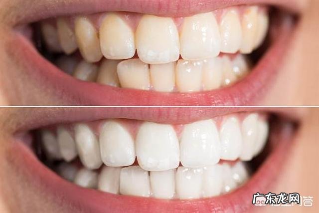 牙齿黄，最健康？