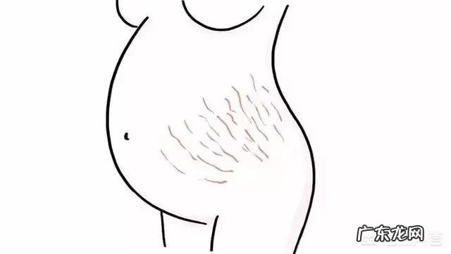 为什么产后还有妊娠纹?