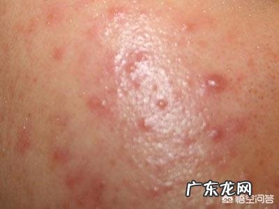 怎么消除青春痘?