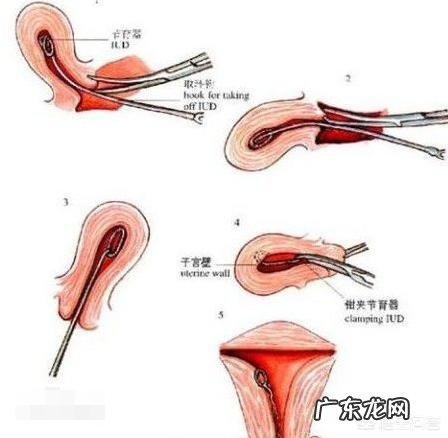 取环后多长时间能怀孕?