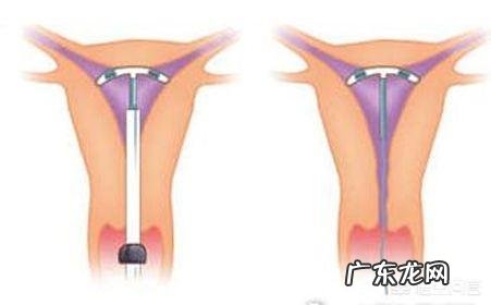 取环后多长时间能怀孕?