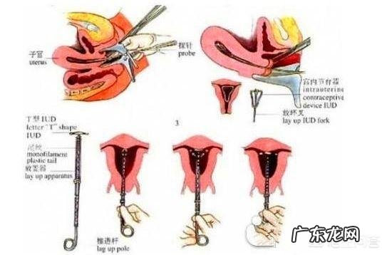 取环后多长时间能怀孕?