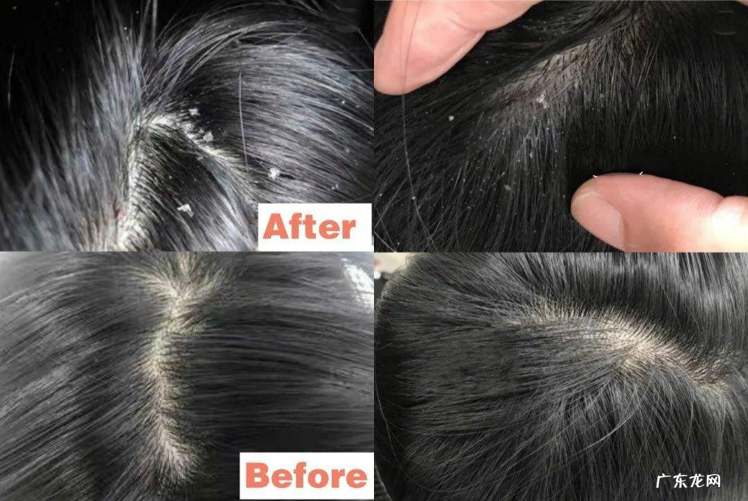 最有效实用去除头皮屑小妙招