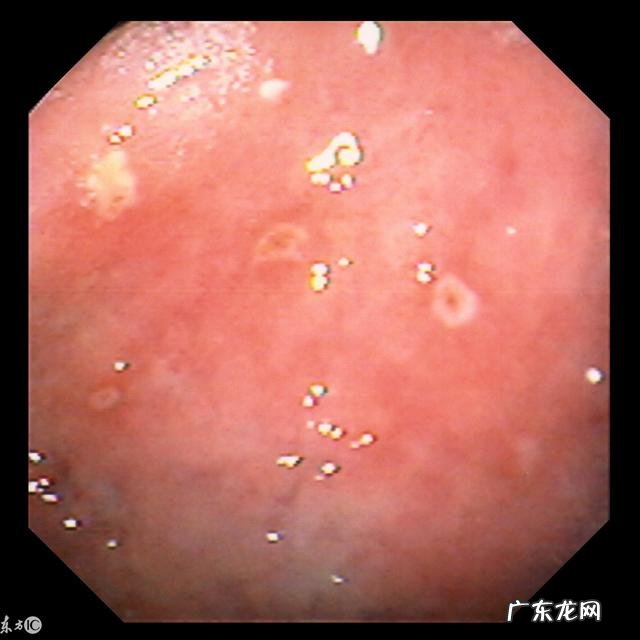 奥美拉唑有没有副作用呢?