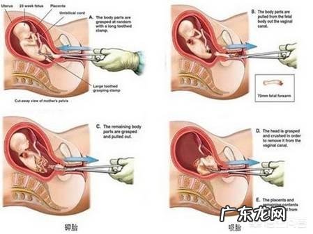 做完人流需要休息多久?有哪些需要注意的?
