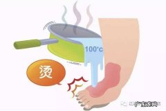 被开水烫到怎么解决