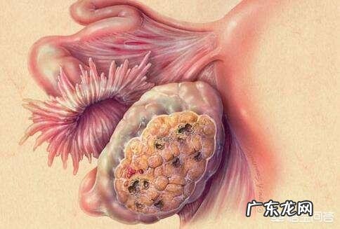 卵巢肿瘤的早期症状有哪些?