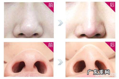隆鼻会有什么后遗症?