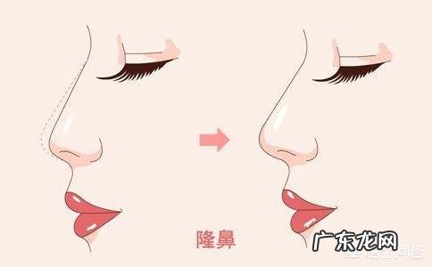隆鼻会有什么后遗症?