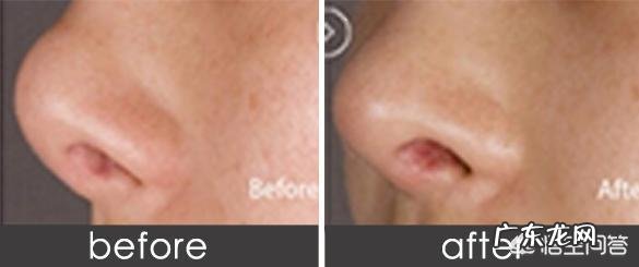 隆鼻会有什么后遗症?