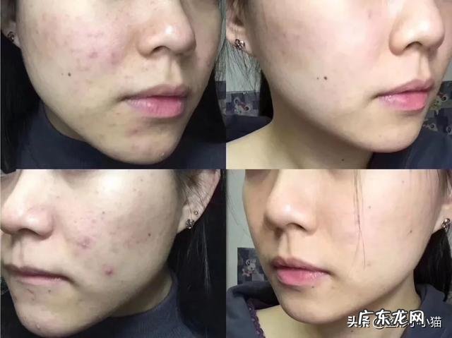 有人做个光子嫩肤吗?祛痘印效果怎么样?