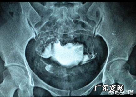 是什么原因造成输卵管的堵塞？