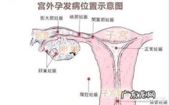 造成宫外孕的原因是什么？切除输卵管之后对身体有什么伤害？