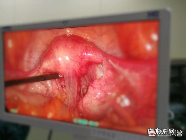 造成宫外孕的原因是什么?切除输卵管之后对身体有什么伤害?