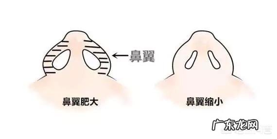 鼻孔大,鼻翼肥厚难看怎么办?