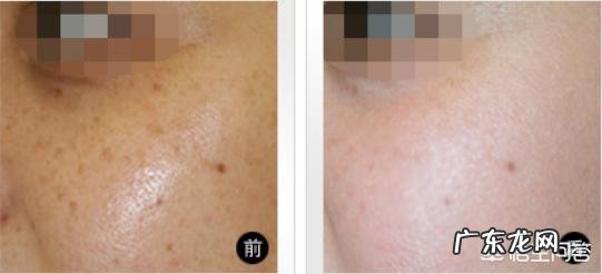 彩光嫩肤、点阵激光、光子嫩肤有什么区别?