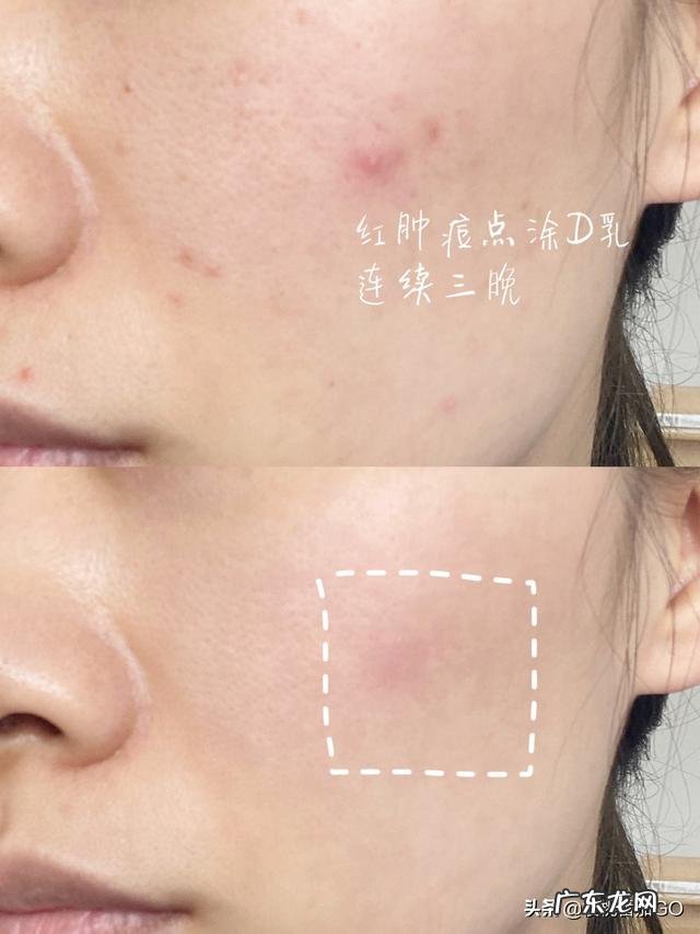 有什么祛痘祛痘印效果好的方法或者产品?