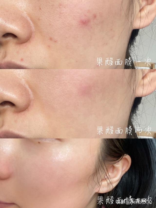 有什么祛痘祛痘印效果好的方法或者产品?