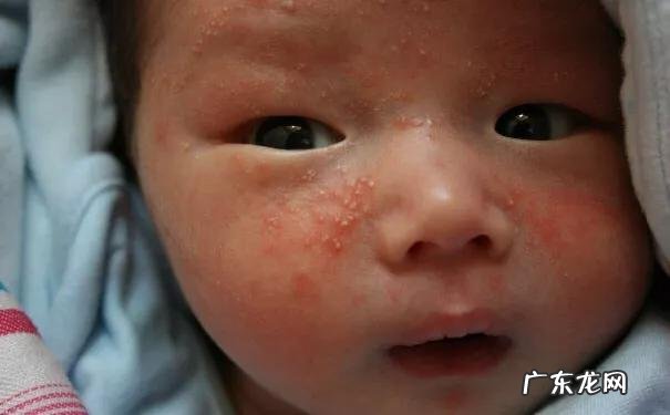 婴幼儿湿疹可以使用药膏吗?