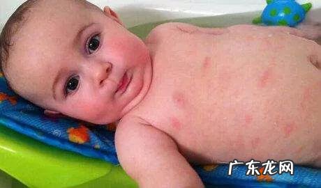 婴幼儿湿疹可以使用药膏吗?