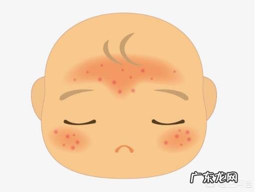 婴幼儿湿疹可以使用药膏吗?