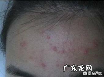 额头起痘,出油咋办?
