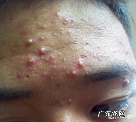 额头起痘,出油咋办?