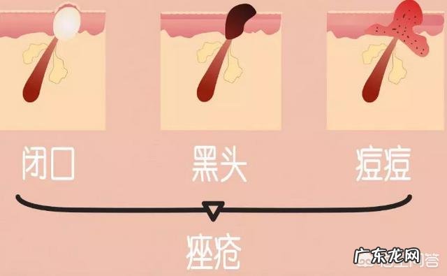 额头起痘,出油咋办?