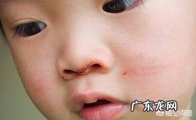 小孩出鼻血可能是得什么病?