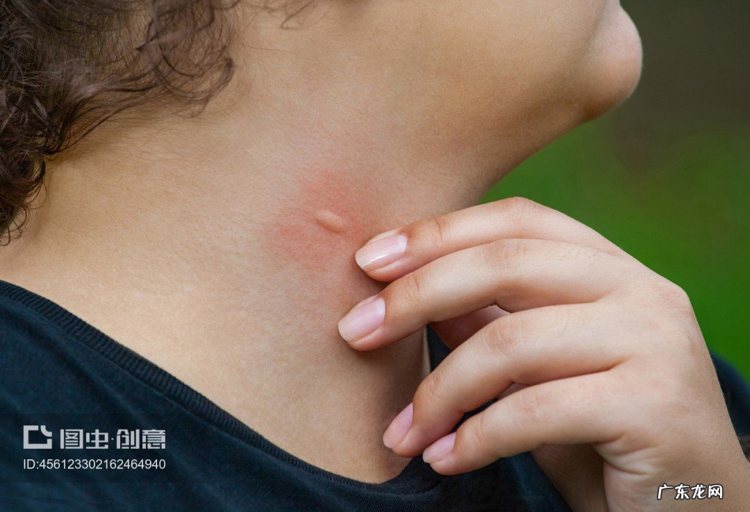 被蚊子咬过的人会怎么样