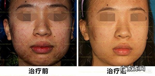 这些痘疤痘坑有救吗?