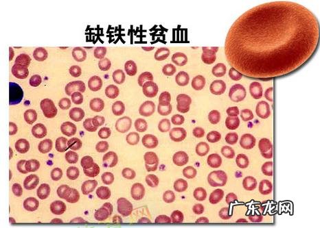 贫血吃什么,怎么补铁?