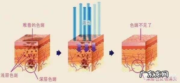 生完孩子脸颊两旁就长了黄褐斑,现在颜色越来越深了,大家有哪些好的祛斑产品推荐?