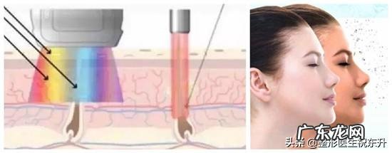 光子嫩肤能维持多长时间，有副作用吗？