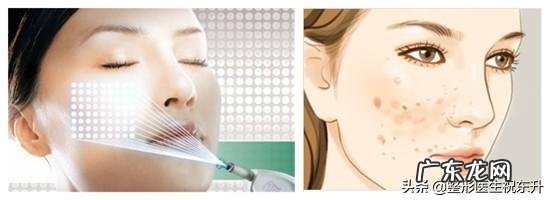 光子嫩肤能维持多长时间，有副作用吗？