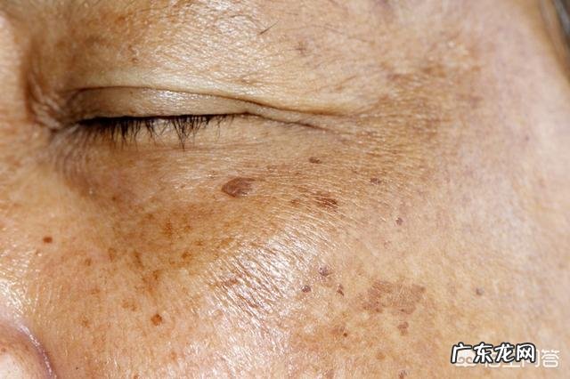 怎样祛斑才是最有效、最安全的?
