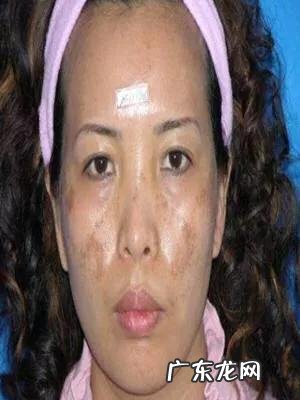 怎样祛斑才是最有效、最安全的?