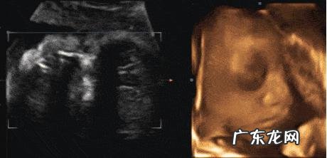 四维彩超都做,既然生出是唐氏综合症宝宝而且有先心病,医院有责任吗?