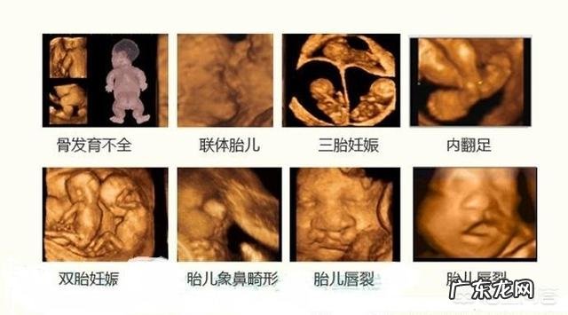 四维彩超都做,既然生出是唐氏综合症宝宝而且有先心病,医院有责任吗?