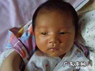 婴儿黄疸正常值是多少?