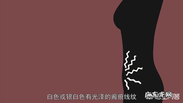 妊娠纹可以去掉吗？