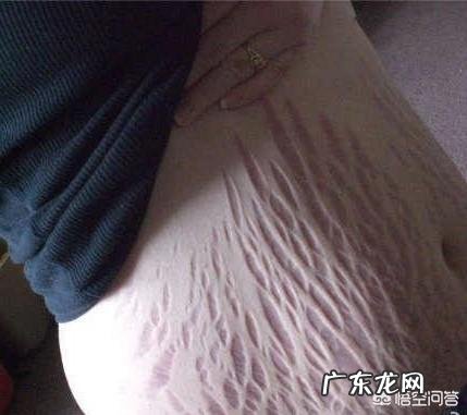 妊娠纹可以去掉吗?