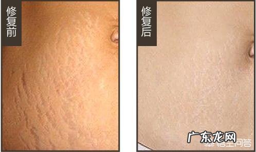 妊娠纹可以去掉吗？