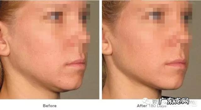 有双下巴怎么才能减掉？