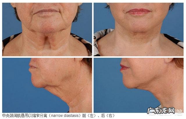 有双下巴怎么才能减掉？