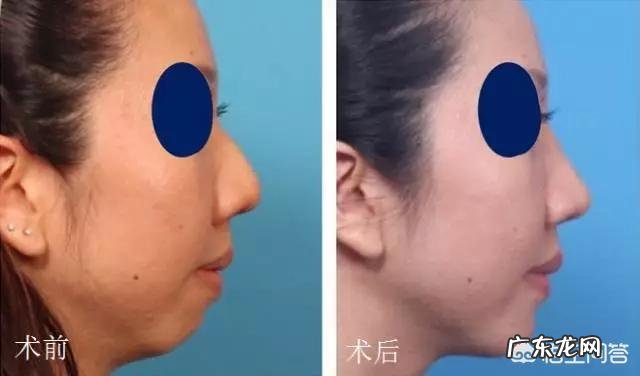 有双下巴怎么才能减掉？