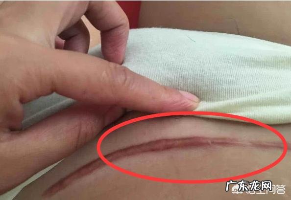剖腹产的后遗症你们有吗?