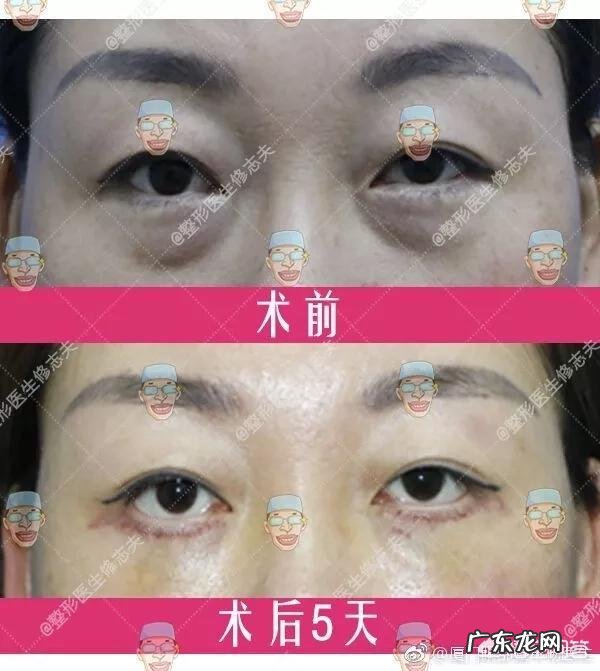 有眼袋是什么原因?