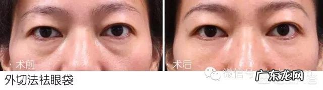 有眼袋是什么原因?