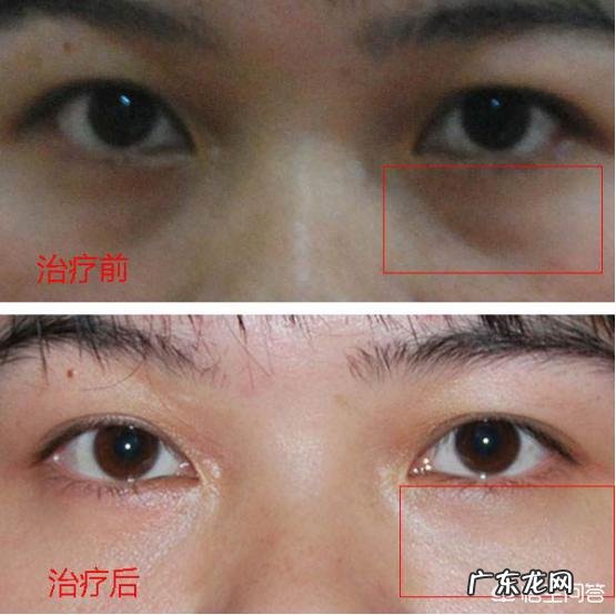 有眼袋是什么原因?